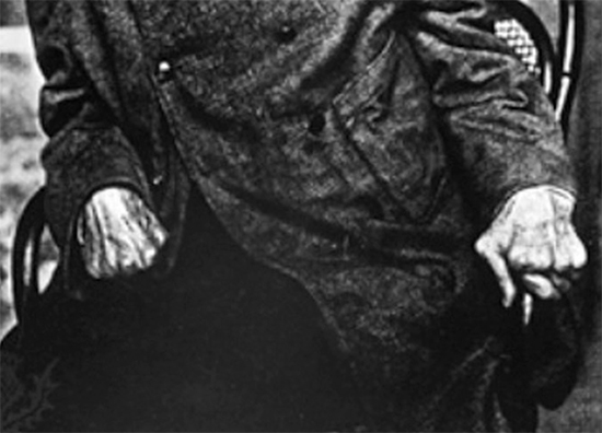 Photograph of Renoir's Hands Late in His Life
